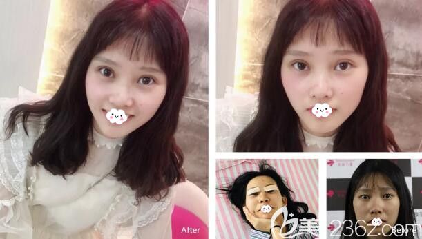 <!--<i data=20240703-sp></li>
?
<li><i data=20240703-sp></i>-->雙眼皮案例恢復(fù)過程圖