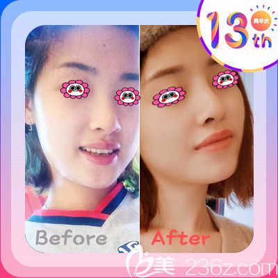 湘潭雅美整形醫(yī)院隆鼻效果圖