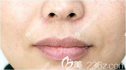 冰點(diǎn)脫唇毛后效果怎么樣？看沈陽(yáng)百嘉麗整形醫(yī)院超冰脫唇毛真人案例效果就知道了！