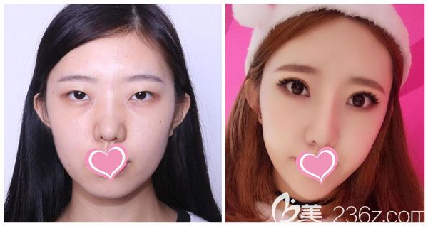 肖育亮做全切雙眼皮+開眼角效果對比圖 肖育亮做全切雙眼皮+開眼角效果對比圖