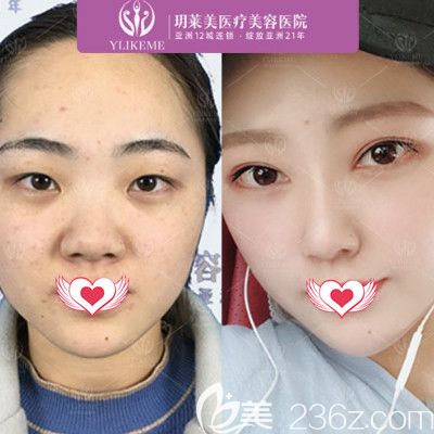 玥萊美整形醫(yī)院做雙眼皮案例 玥萊美整形醫(yī)院做雙眼皮案例