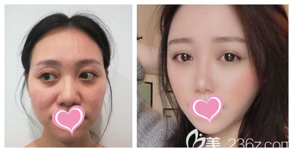 胡喬做面部自體脂肪填充效果對比圖 胡喬做面部自體脂肪填充效果對比圖