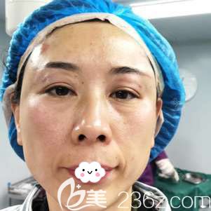 <!--<i data=20240703-sp></i>-->自體脂肪豐眼窩術(shù)后效果