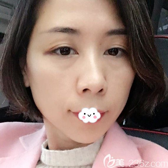 <!--<i data=20240703-sp></i>-->自體脂肪填充眼窩術(shù)后恢復(fù)效果圖