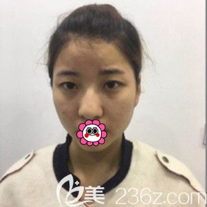 <!--<i data=20240703-sp></i>-->肋軟骨隆鼻術(shù)前 <!--<i data=20240703-sp></i>-->肋軟骨隆鼻術(shù)前