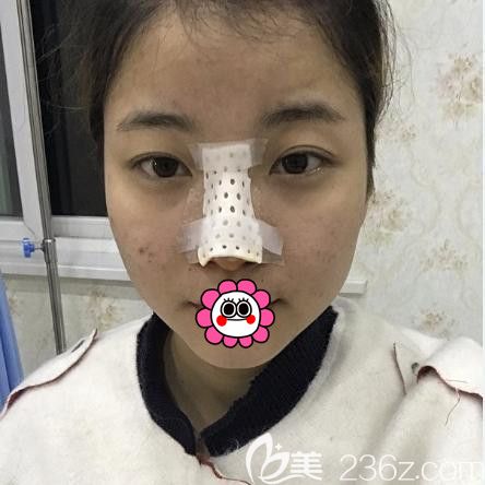 <!--<i data=20240703-sp></i>-->肋軟骨隆鼻5天 <!--<i data=20240703-sp></i>-->肋軟骨隆鼻5天