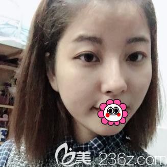 <!--<i data=20240703-sp></i>-->肋軟骨隆鼻術(shù)后20天<span style= <!--<i data=20240703-sp></i>-->肋軟骨隆鼻術(shù)后20天<span style=