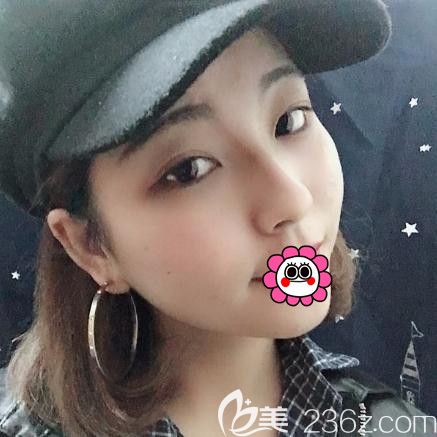 猶豫不定的時(shí)候碰到邀約親診，果斷做了肋軟骨隆鼻