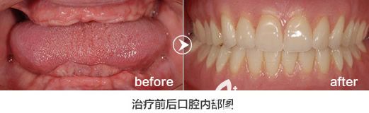 格倫菲爾口腔劉君主任全口種植牙案例