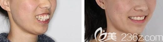 深圳格倫菲爾口腔劉君牙齒矯正案例