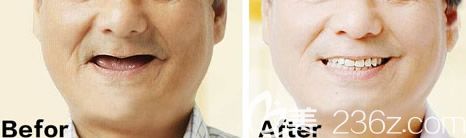 深圳格倫菲爾口腔種植牙案例