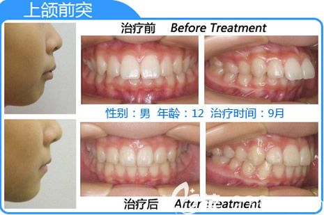 深圳格倫菲爾口腔隱形牙齒矯正案例