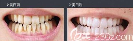 格倫菲爾口腔牙齒冷光美白效果