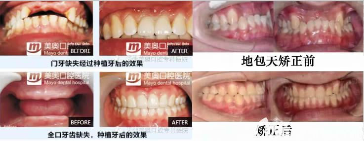 天津美奧種植牙及牙齒矯正案例效果
