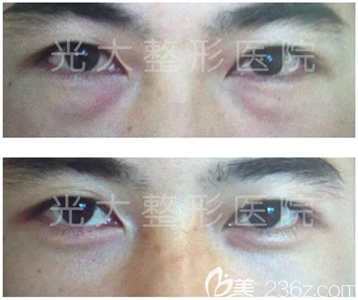 永康光大蔣建光去眼袋案例