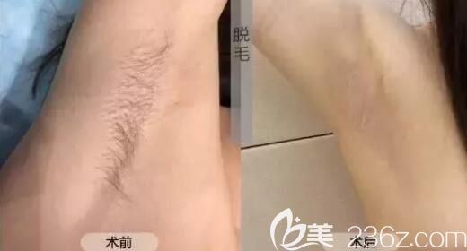 九江星瑞美脫毛案例