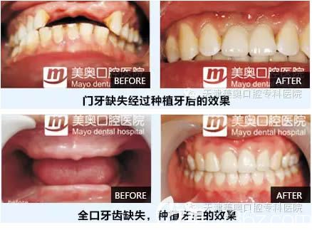 天津美奧口腔權(quán)圣鳳院全口及半口種植牙案例效果圖 天津美奧口腔權(quán)圣鳳院全口及半口種植牙案例效果圖