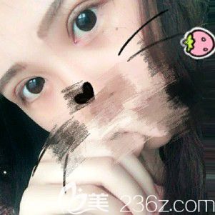 <!--<i data=20240703-sp></i>-->全切雙眼皮15天恢復(fù)圖 <!--<i data=20240703-sp></i>-->全切雙眼皮15天恢復(fù)圖