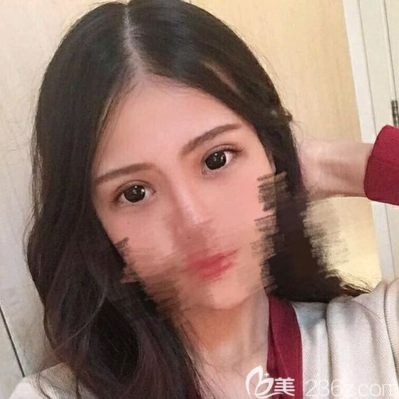 做的全切雙眼皮+開眼角，讓我輕松擁有屬于自己的雙眼皮