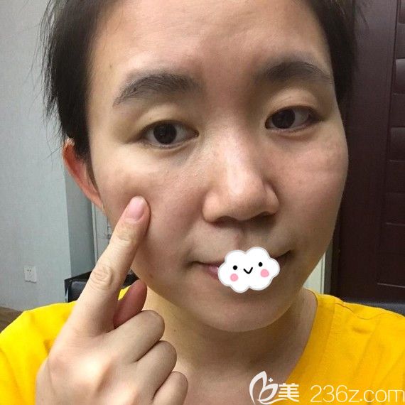 <!--<i data=20240703-sp></i>-->激光祛斑術(shù)后效果