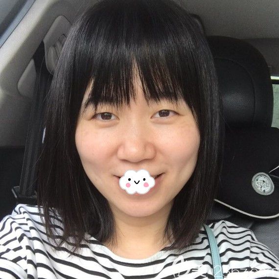 <!--<i data=20240703-sp></i>-->去斑效果怎么樣？皮秒去斑術(shù)后1月照片