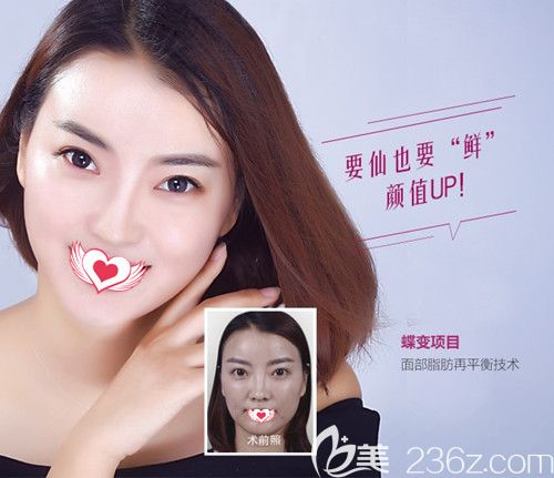 承德美天自體脂肪填充面部 承德美天自體脂肪填充面部