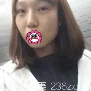 <!--<i data=20240703-sp></i>-->自體脂肪面部填充前 <!--<i data=20240703-sp></i>-->自體脂肪面部填充前