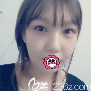 <!--<i data=20240703-sp></i>-->面部填充20天效果 <!--<i data=20240703-sp></i>-->面部填充20天效果