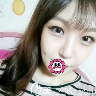 做自體脂肪填充面部怎么樣？看我做完40天案例效果就知道啦