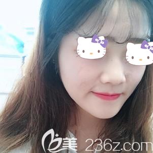 想變上鏡小V臉到贛州亞韓醫(yī)療美容醫(yī)院找吳禮誠主任做瘦臉除皺瘦臉后果然沒讓我失望