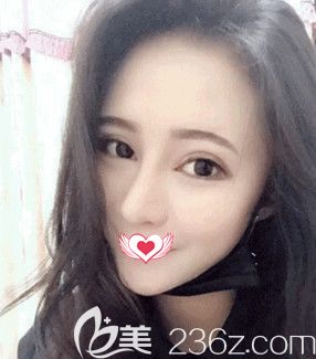 陳譽華院長做眼鼻綜合整形術(shù)后10天已經(jīng)消腫 陳譽華院長做眼鼻綜合整形術(shù)后10天已經(jīng)消腫