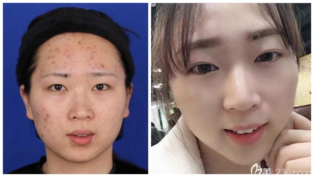 3月女神節(jié)合肥壹美尚超低折扣價格表上線，蜂巢皮秒首次體驗(yàn)僅需1980元/雙眼皮+開眼角低至3800元