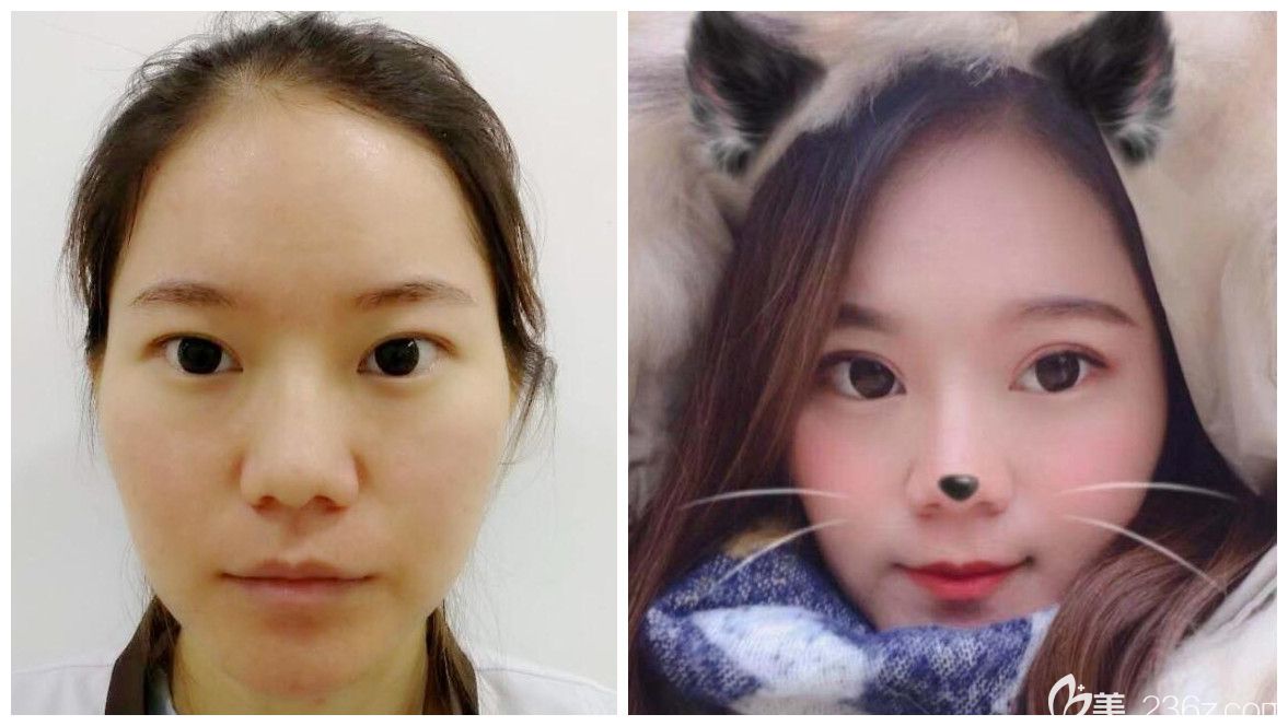 合肥哪里割雙眼皮好？合肥壹美尚雙眼皮案例一覽