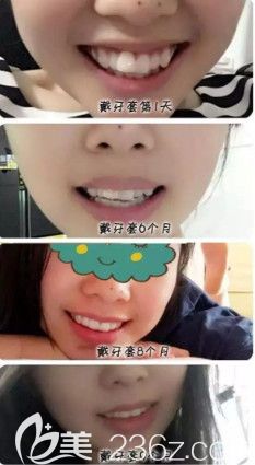 韓永剛醫(yī)生做隱形矯正案例 韓永剛醫(yī)生做隱形矯正案例