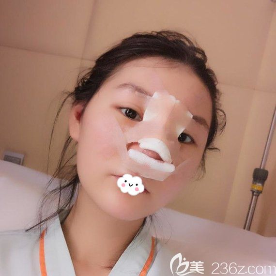 武漢藝星楊國梁假體隆鼻+耳軟骨墊鼻尖案例