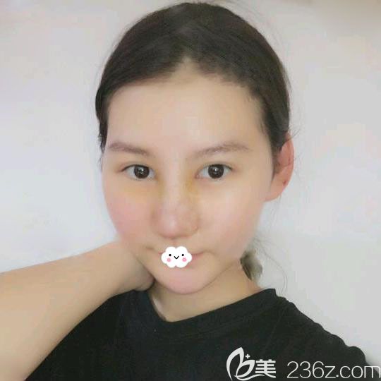 武漢藝星楊國梁隆鼻術(shù)后恢復(fù)圖