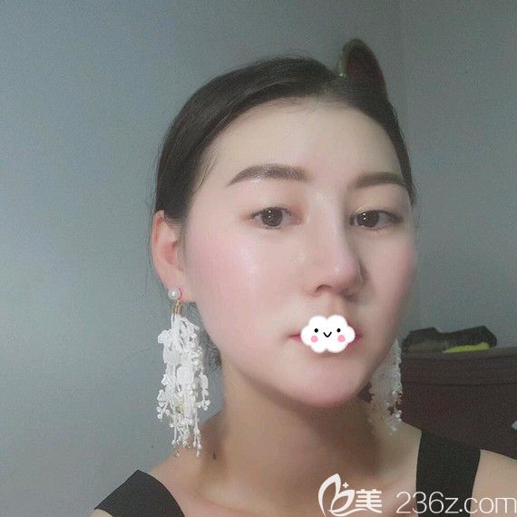 武漢藝星鼻綜合效果怎么樣？楊國梁案例