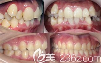 格倫菲爾口腔周道平醫(yī)生牙齒矯正案例