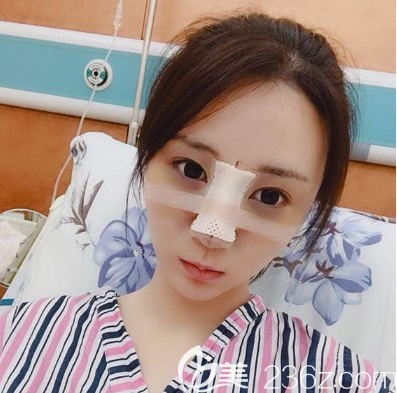 佛山佳麗整形隆鼻術(shù)后兩天