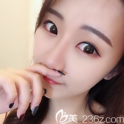 佛山佳麗整形做隆鼻子效果怎么樣