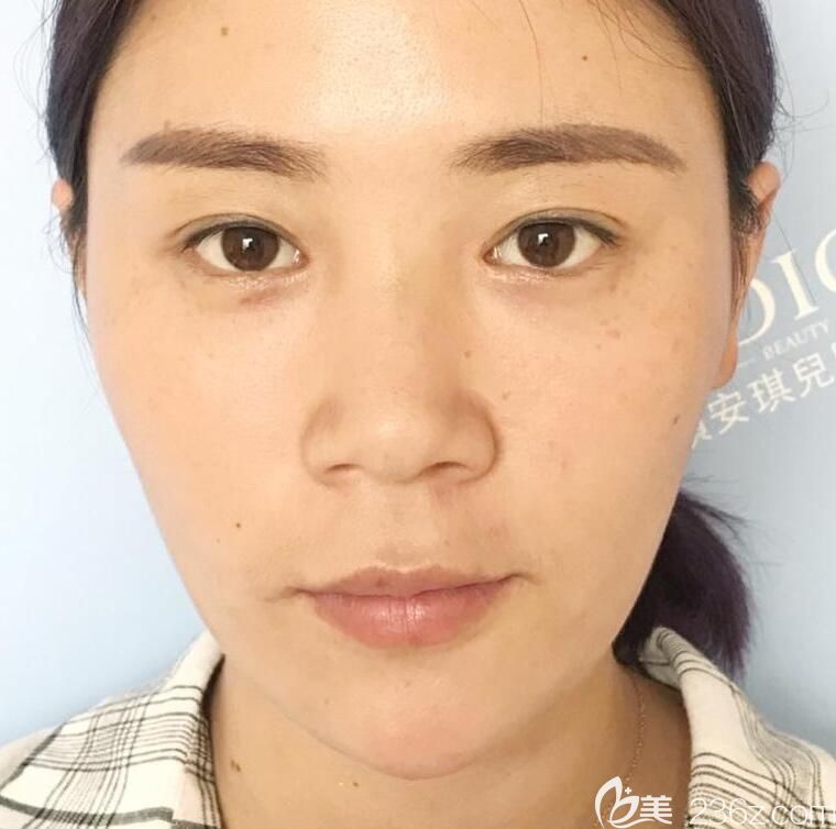 去合肥白領(lǐng)安琪兒隆鼻術(shù)前 去合肥白領(lǐng)安琪兒隆鼻術(shù)前