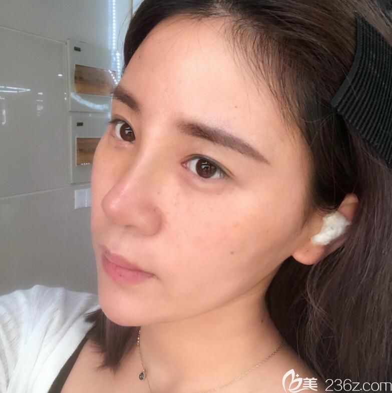 合肥安琪兒鼻綜合隆鼻術(shù)后第5天情況 合肥安琪兒鼻綜合隆鼻術(shù)后第5天情況