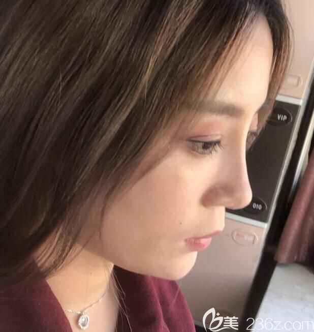 安琪兒假體隆鼻鼻綜合術(shù)后第7天圖 安琪兒假體隆鼻鼻綜合術(shù)后第7天圖