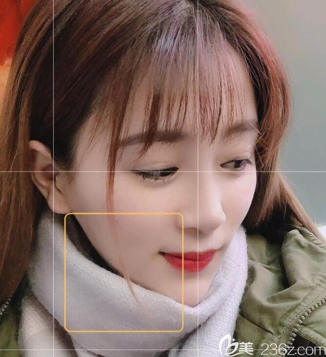 我找合肥白領(lǐng)安琪兒胡準(zhǔn)院長做韓式生科二段加耳軟骨隆鼻