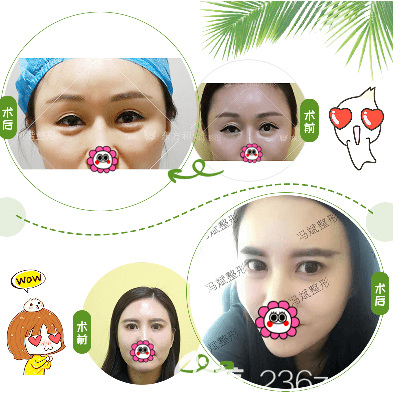 北京純脂王自謙自體脂肪豐臥蠶