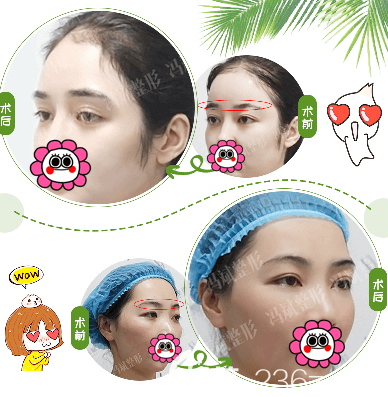 北京純脂自體脂肪豐眉弓