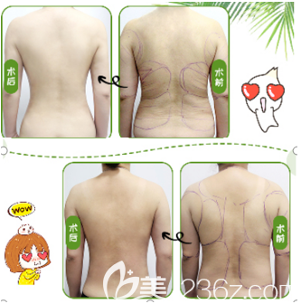 北京純脂馮斌整形背部吸脂