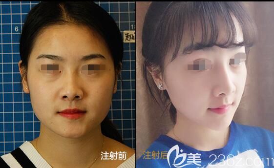 顏廷偉醫(yī)生注射隆鼻+下巴案例 顏廷偉醫(yī)生注射隆鼻+下巴案例