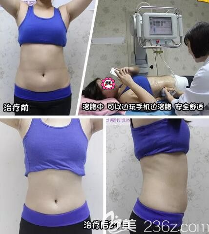 百嘉麗超聲溶脂真人案例效果對比