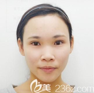 日本十仁做假體隆鼻加耳軟骨墊鼻尖前 日本十仁做假體隆鼻加耳軟骨墊鼻尖前